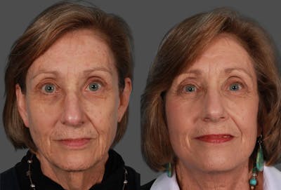 Facelift Before & After Gallery - Patient 262271 - Image 1