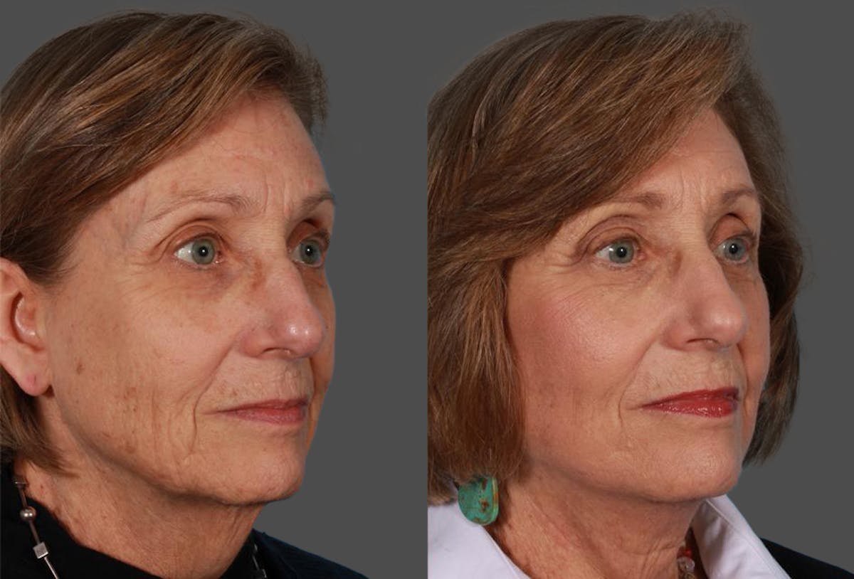 Facelift Before & After Gallery - Patient 262271 - Image 2