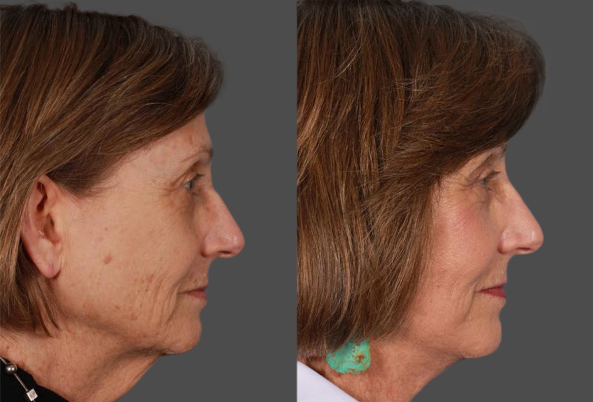 Facelift Before & After Gallery - Patient 262271 - Image 3