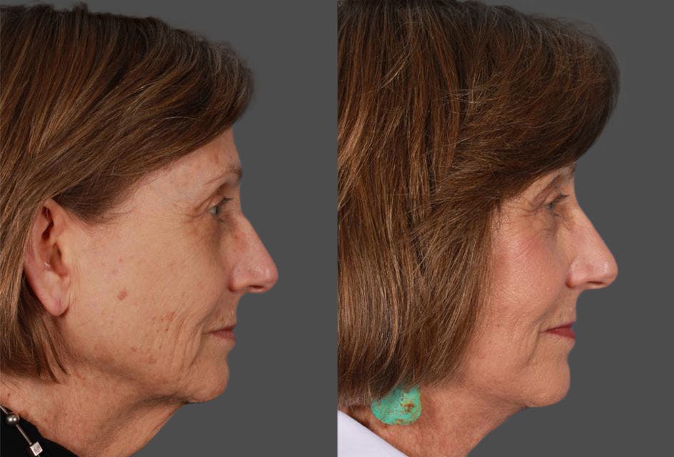 Facelift Before & After Gallery - Patient 262271 - Image 3