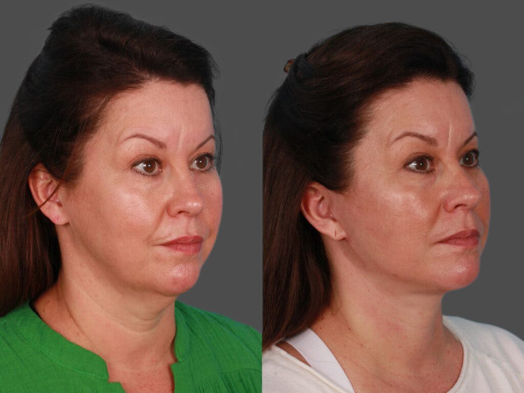 Facelift Before & After Gallery - Patient 337677 - Image 2