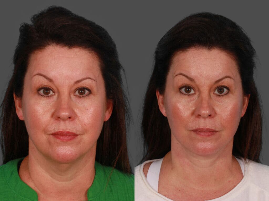 Facelift Before & After Gallery - Patient 337677 - Image 1