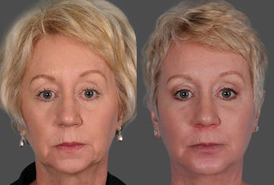 Facelift Before & After Gallery - Patient 357337 - Image 1