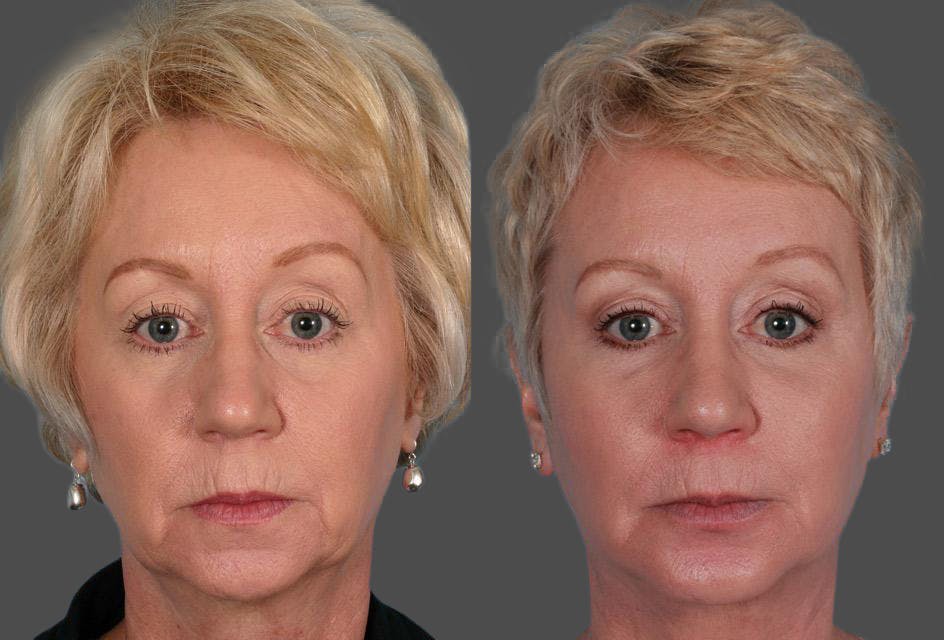 Facial Fat Transfer Before & After Gallery - Patient 138939 - Image 1