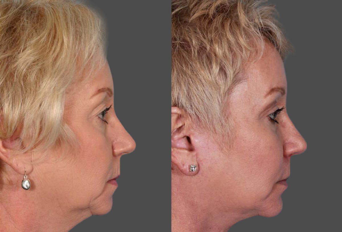 Facial Fat Transfer Before & After Gallery - Patient 138939 - Image 3