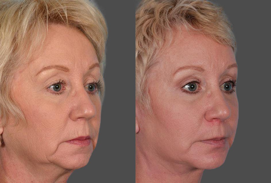Facial Fat Transfer Before & After Gallery - Patient 138939 - Image 2