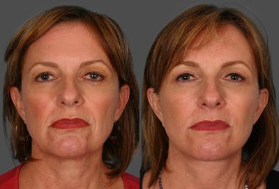 Facelift Before & After Gallery - Patient 332223 - Image 1