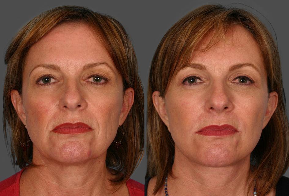Facelift Before & After Gallery - Patient 332223 - Image 1