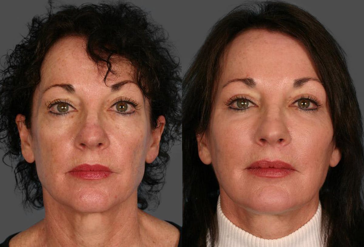 Facial Fat Transfer Before & After Gallery - Patient 306425 - Image 1