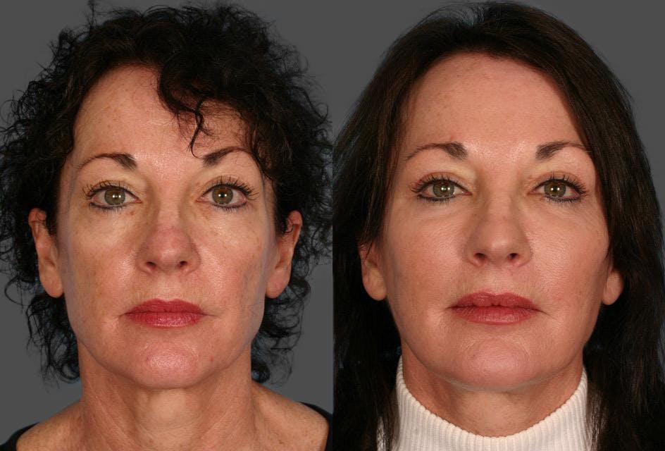 Facial Fat Transfer Before & After Gallery - Patient 306425 - Image 1