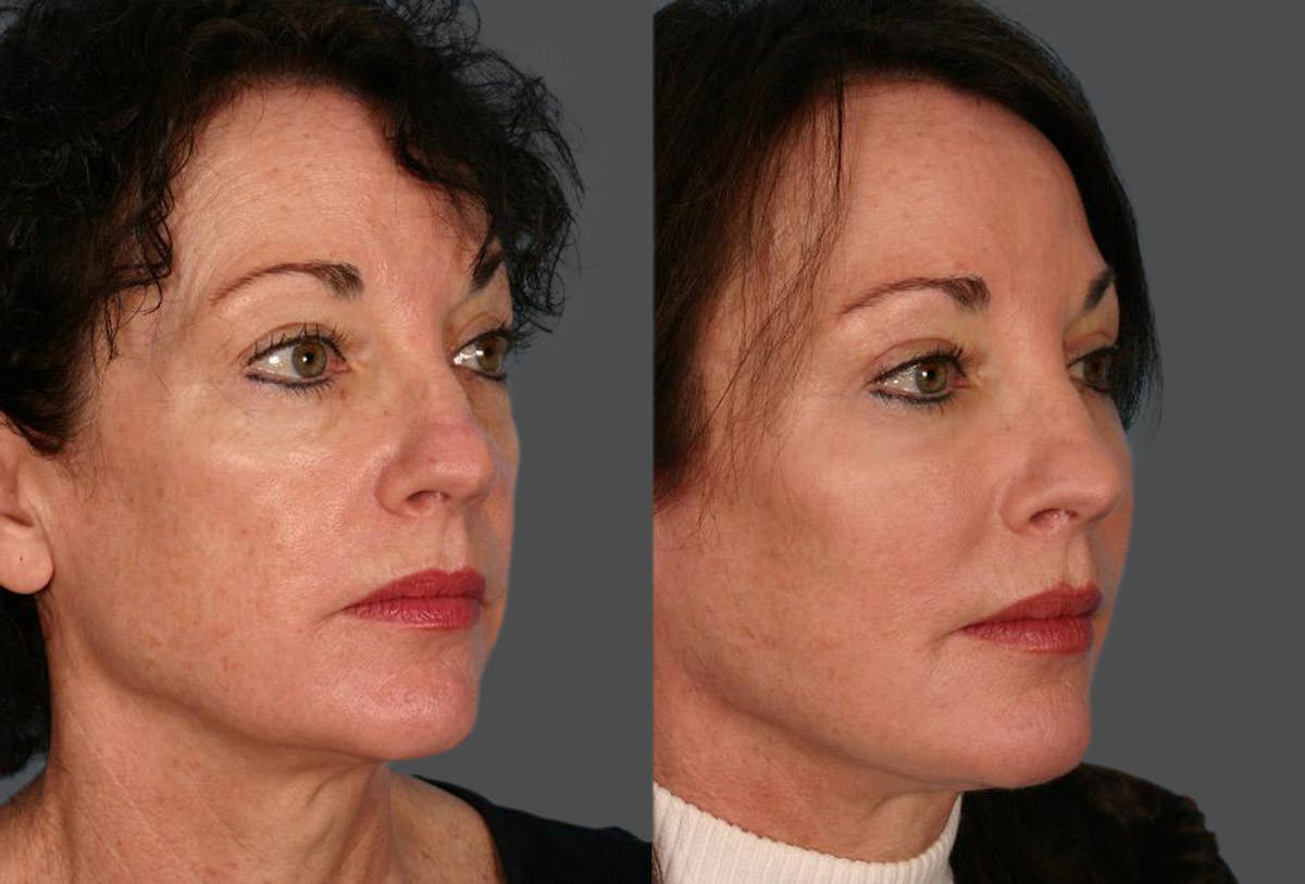 Facial Fat Transfer Before & After Gallery - Patient 306425 - Image 2