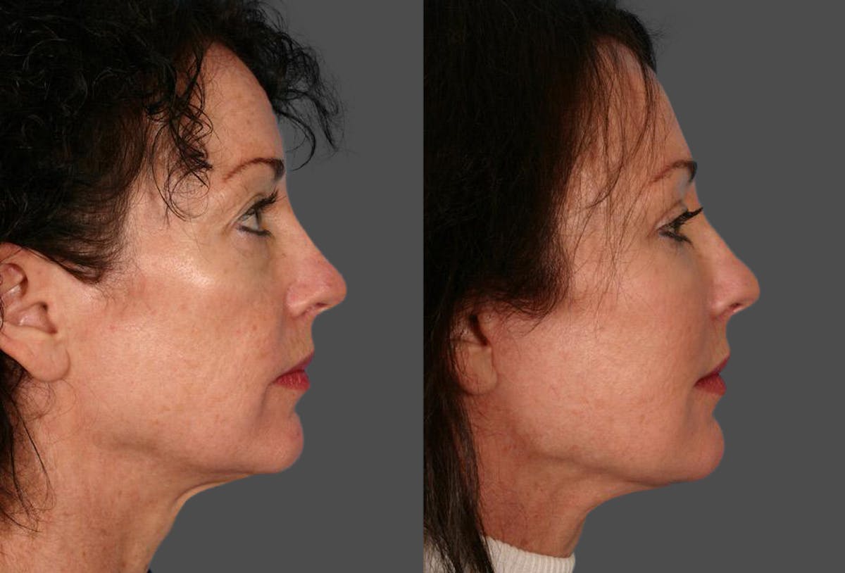 Facial Fat Transfer Before & After Gallery - Patient 306425 - Image 3