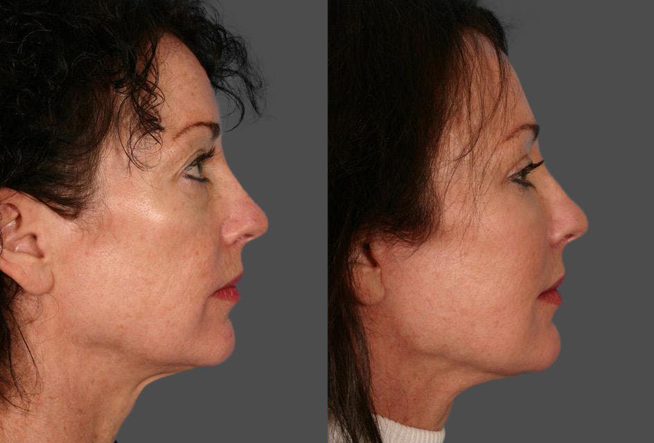 Facial Fat Transfer Before & After Gallery - Patient 306425 - Image 3