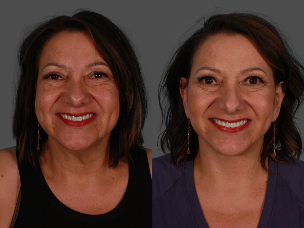 Facelift Before & After Gallery - Patient 300494 - Image 1