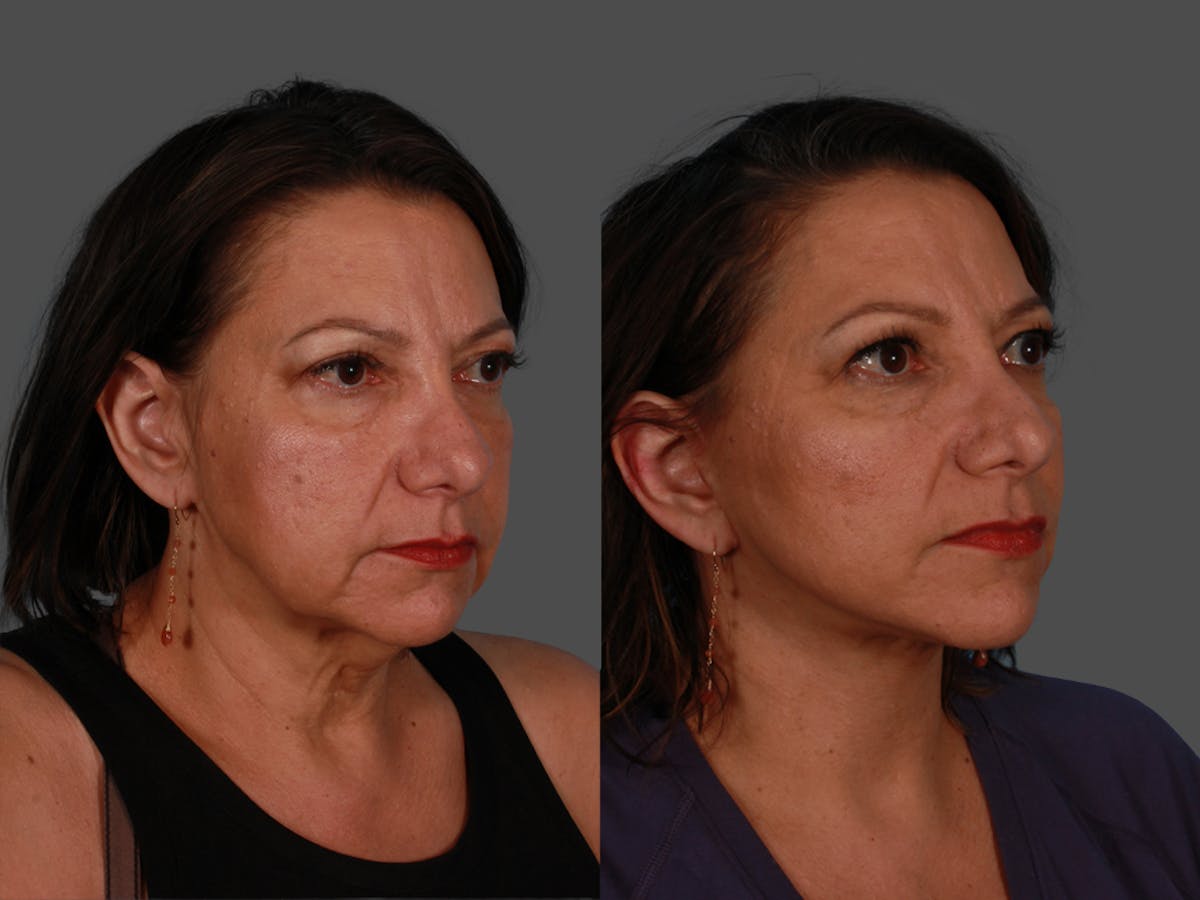 Facelift Before & After Gallery - Patient 300494 - Image 2