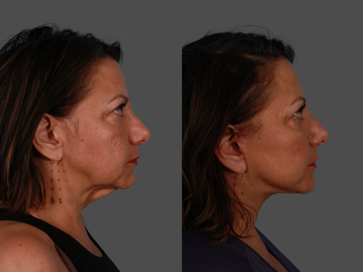Facelift Before & After Gallery - Patient 300494 - Image 3
