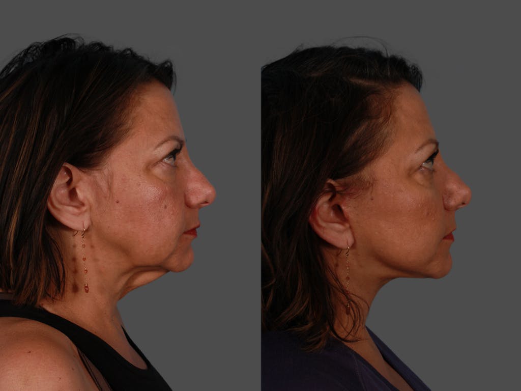 Facelift Before & After Gallery - Patient 300494 - Image 3