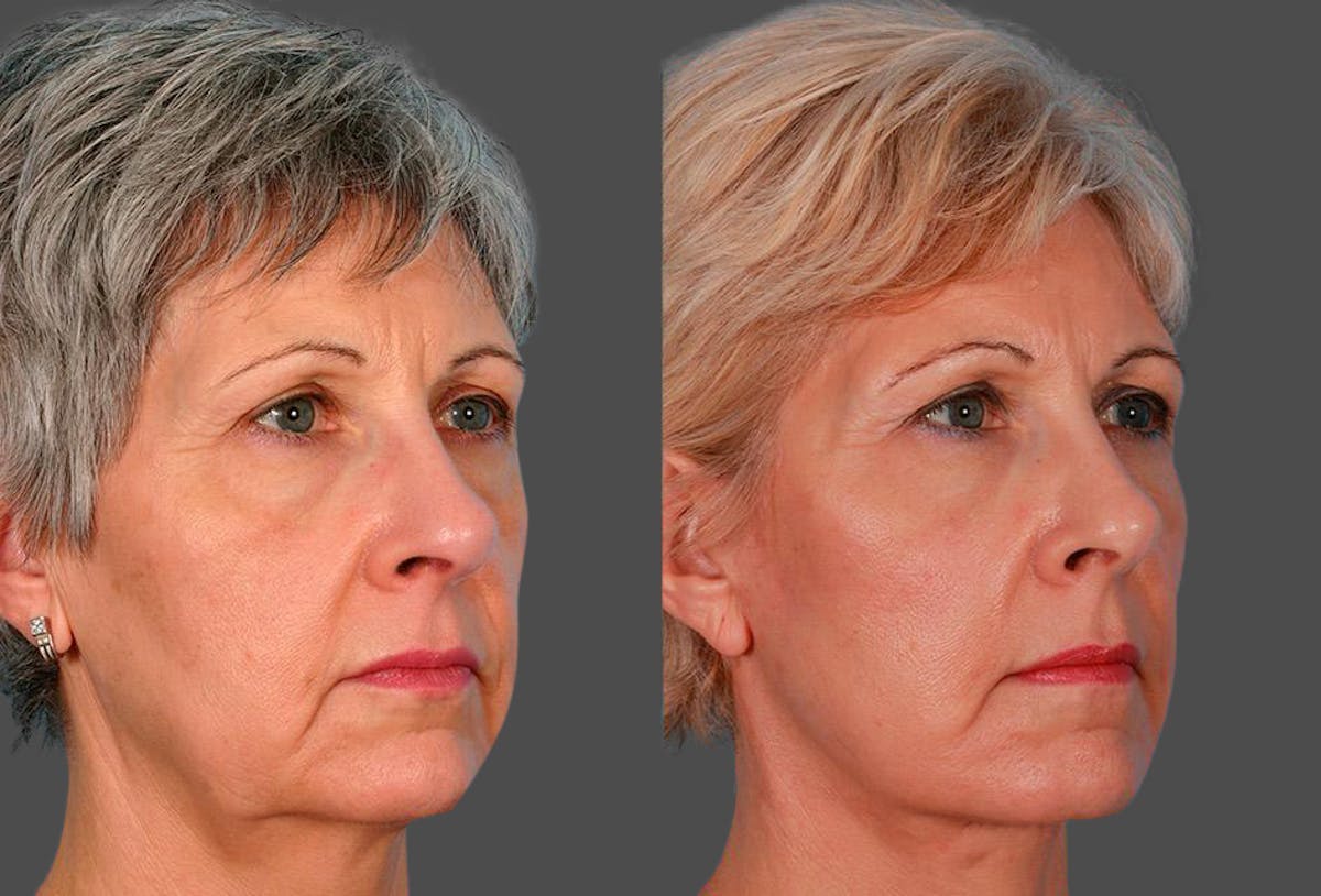 Facelift Before & After Gallery - Patient 396797 - Image 2