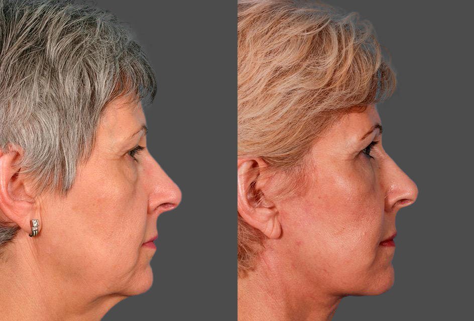 Facelift Before & After Gallery - Patient 396797 - Image 3