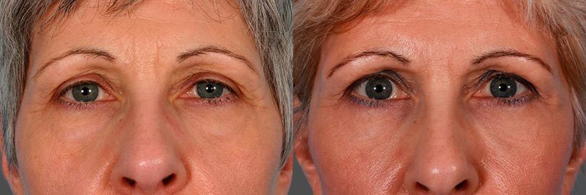 Facelift Before & After Gallery - Patient 396797 - Image 4