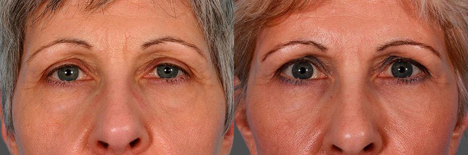 Facelift Before & After Gallery - Patient 396797 - Image 4