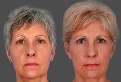 Facelift Before & After Gallery - Patient 396797 - Image 1