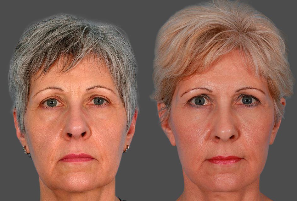Facelift Before & After Gallery - Patient 396797 - Image 1