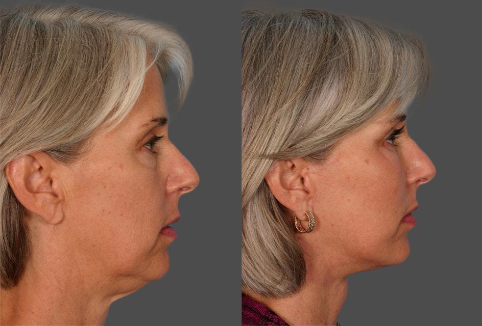 Facelift Before & After Gallery - Patient 389662 - Image 3