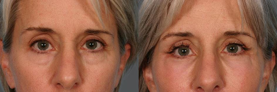 Facelift Before & After Gallery - Patient 389662 - Image 4