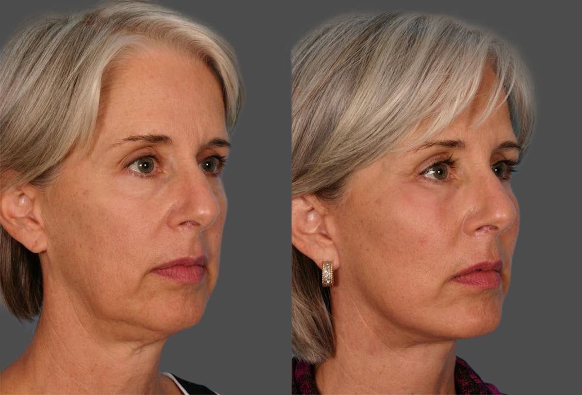 Facelift Before & After Gallery - Patient 389662 - Image 2