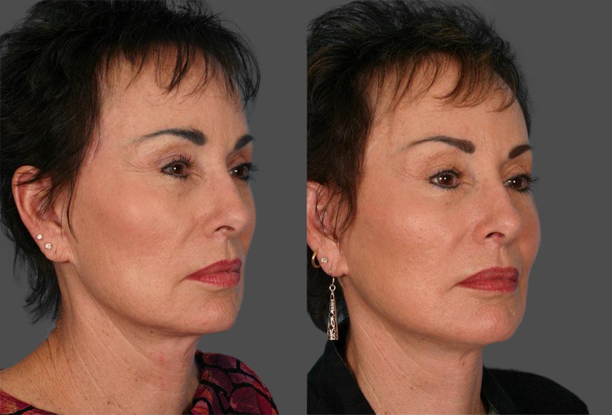 Facelift Before & After Gallery - Patient 384726 - Image 2