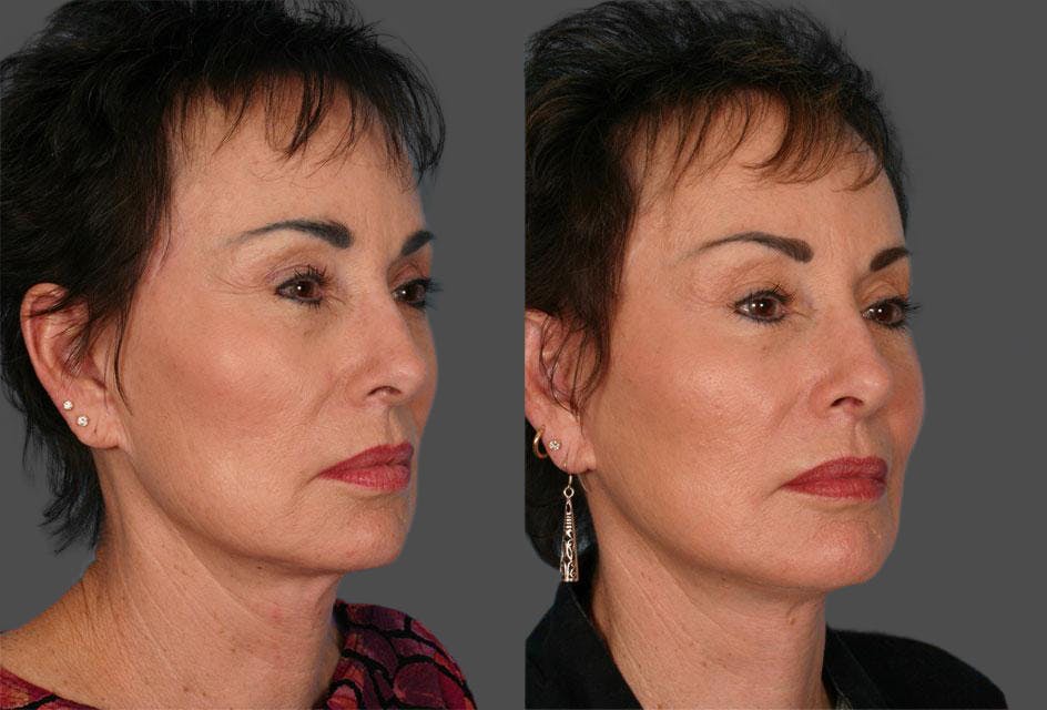 Facelift Before & After Gallery - Patient 384726 - Image 2