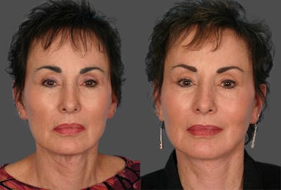 Facelift Before & After Gallery - Patient 384726 - Image 1