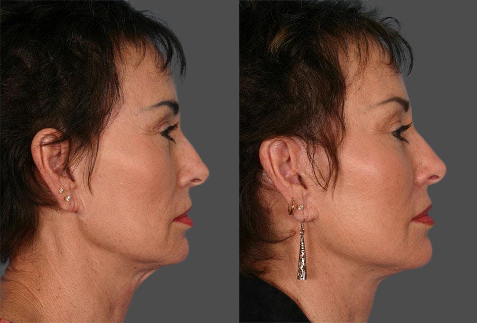 Facelift Before & After Gallery - Patient 384726 - Image 3