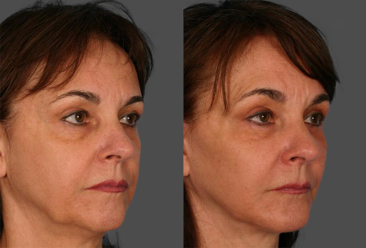 Facelift Before & After Gallery - Patient 364833 - Image 2