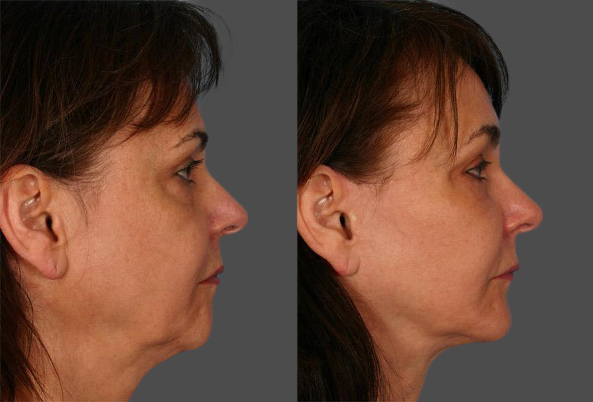 Facelift Before & After Gallery - Patient 364833 - Image 3