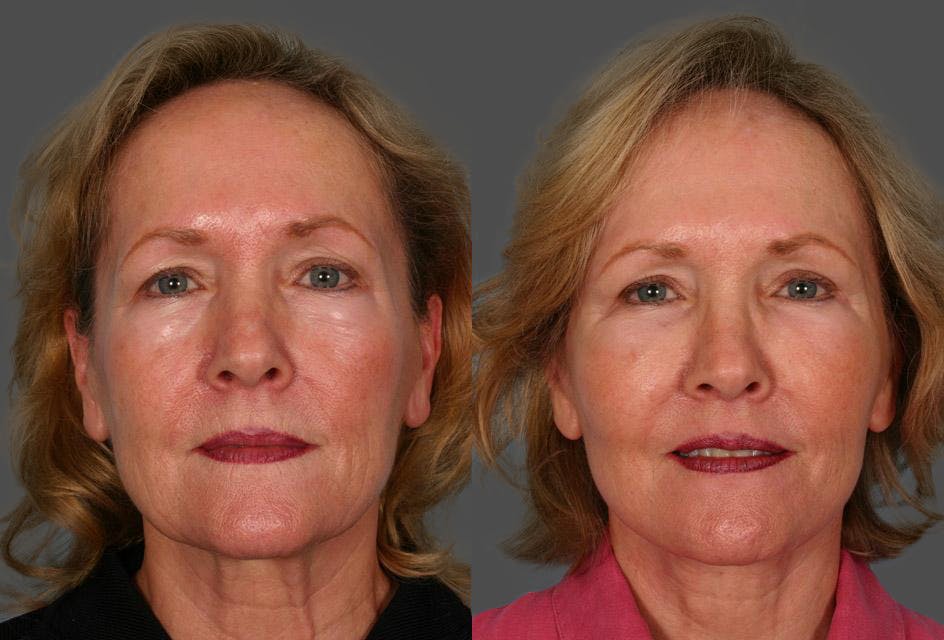 Facelift Before & After Gallery - Patient 377581 - Image 1