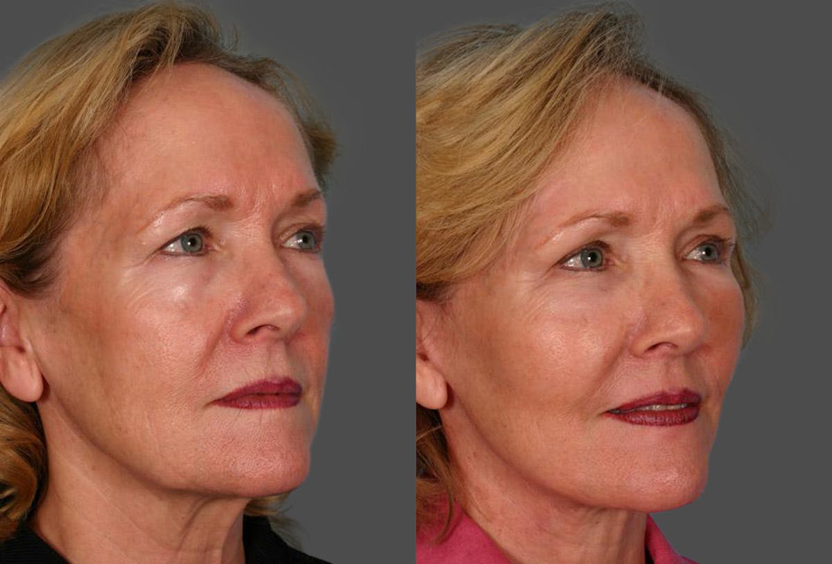 Facelift Before & After Gallery - Patient 377581 - Image 2