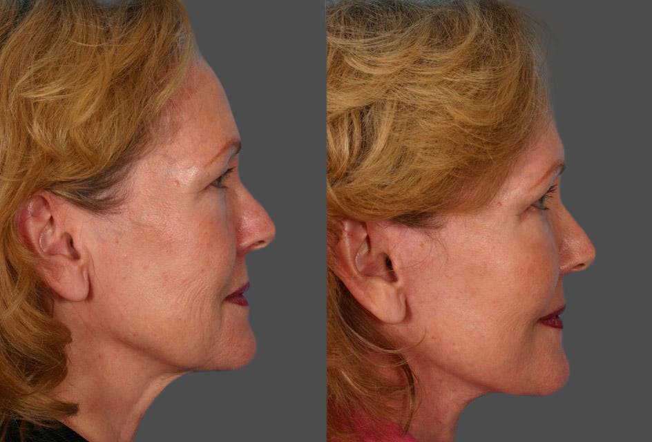 Facelift Before & After Gallery - Patient 377581 - Image 3