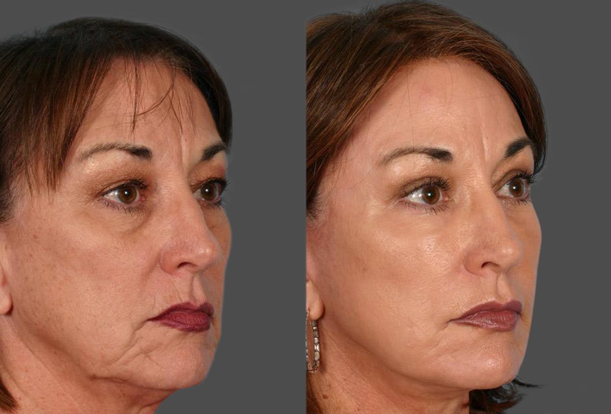 Facelift Before & After Gallery - Patient 966866 - Image 2