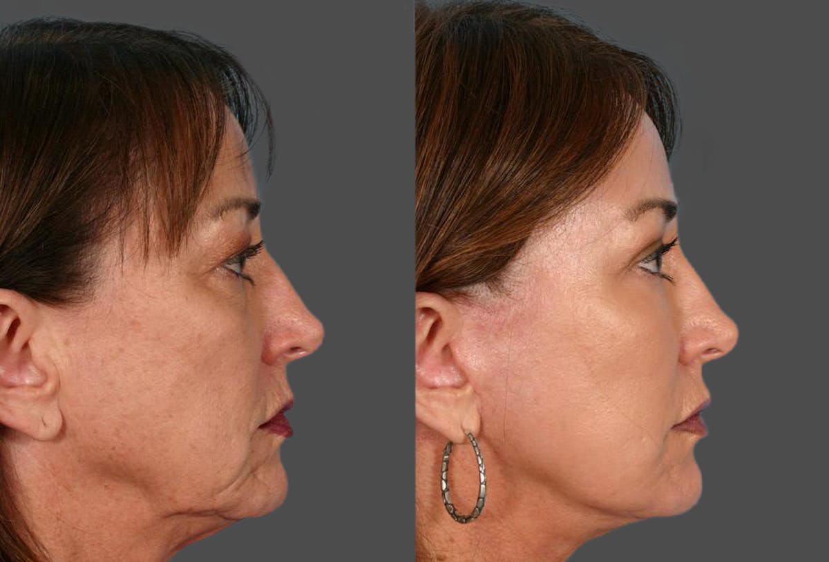 Facelift Before & After Gallery - Patient 966866 - Image 3