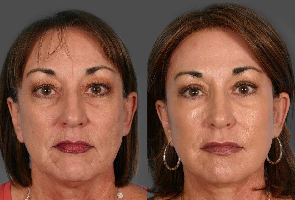Facelift Before & After Gallery - Patient 966866 - Image 1