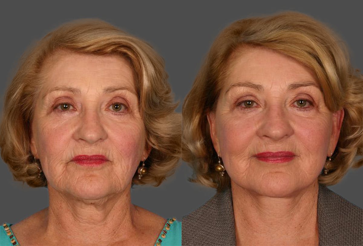 Facelift Before & After Gallery - Patient 731368 - Image 1