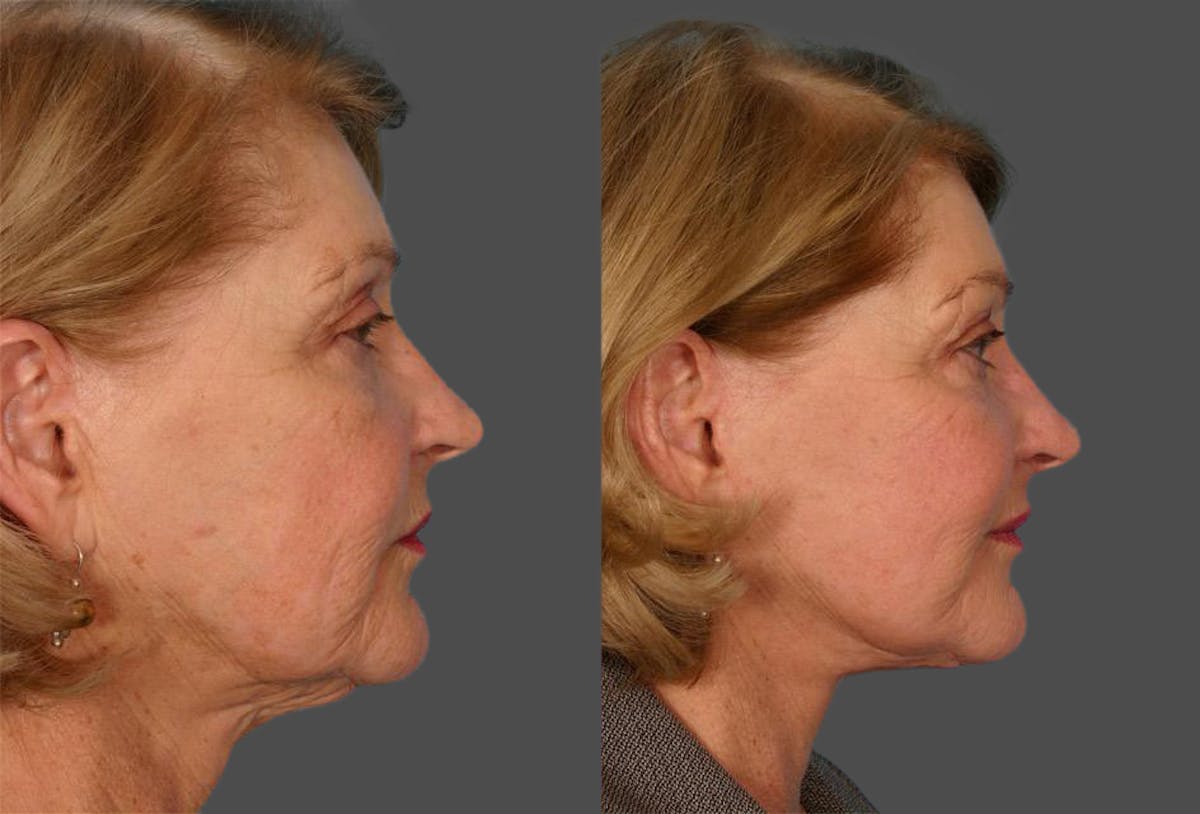 Facelift Before & After Gallery - Patient 731368 - Image 2