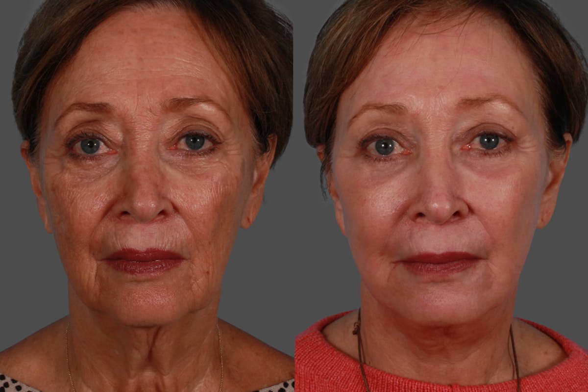 Facelift Before & After Gallery - Patient 579531 - Image 1