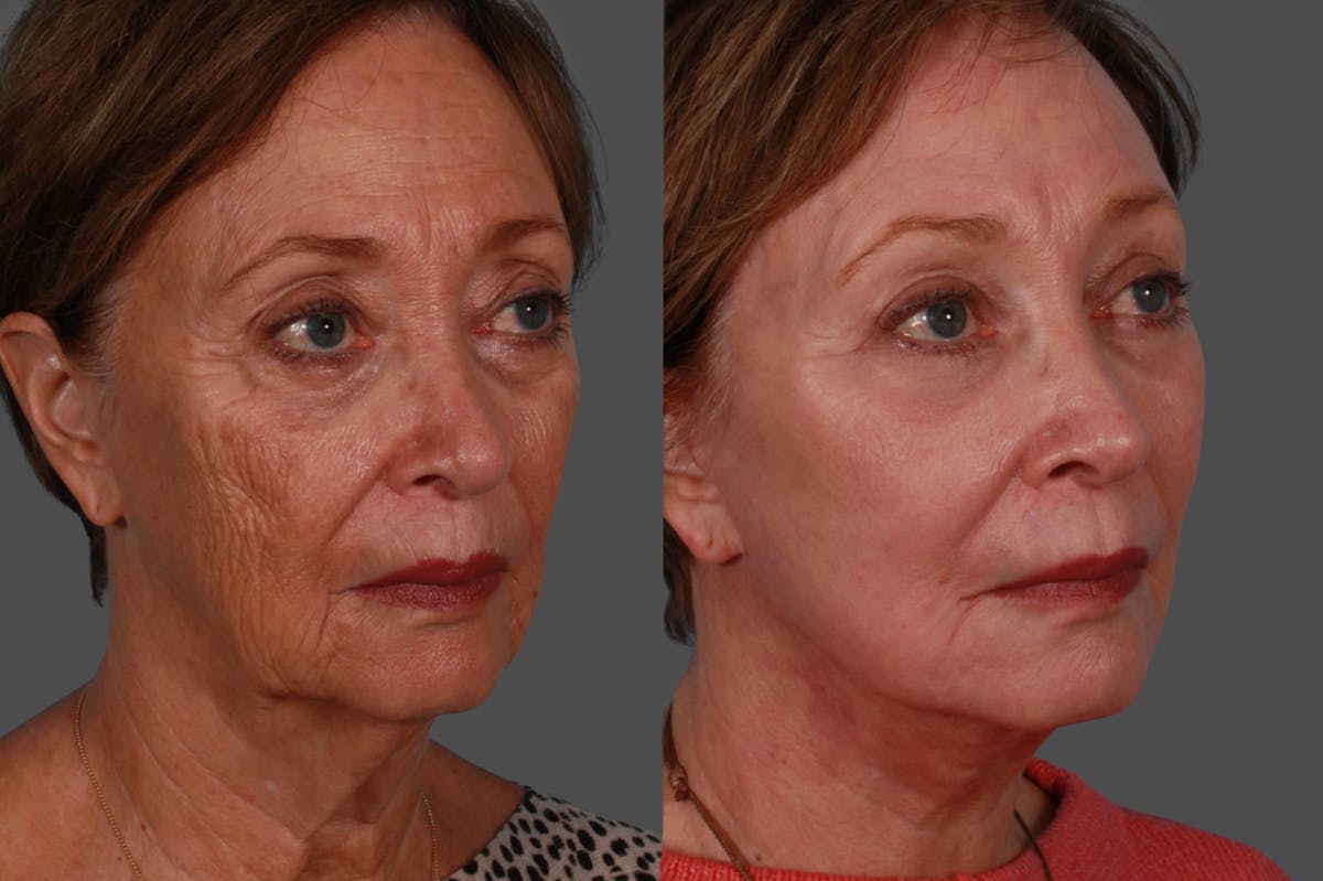 Facelift Before & After Gallery - Patient 579531 - Image 2