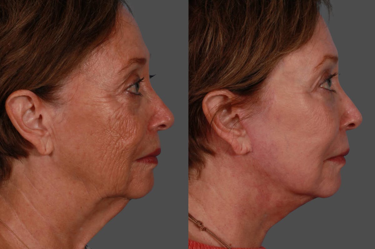 Facelift Before & After Gallery - Patient 579531 - Image 3