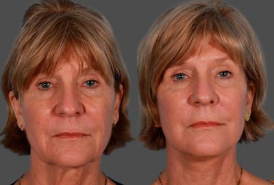 Facelift Before & After Gallery - Patient 504011 - Image 1