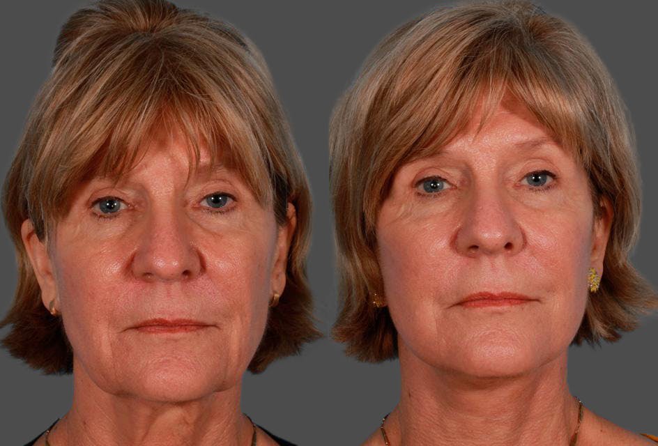 Facelift Before & After Gallery - Patient 504011 - Image 1