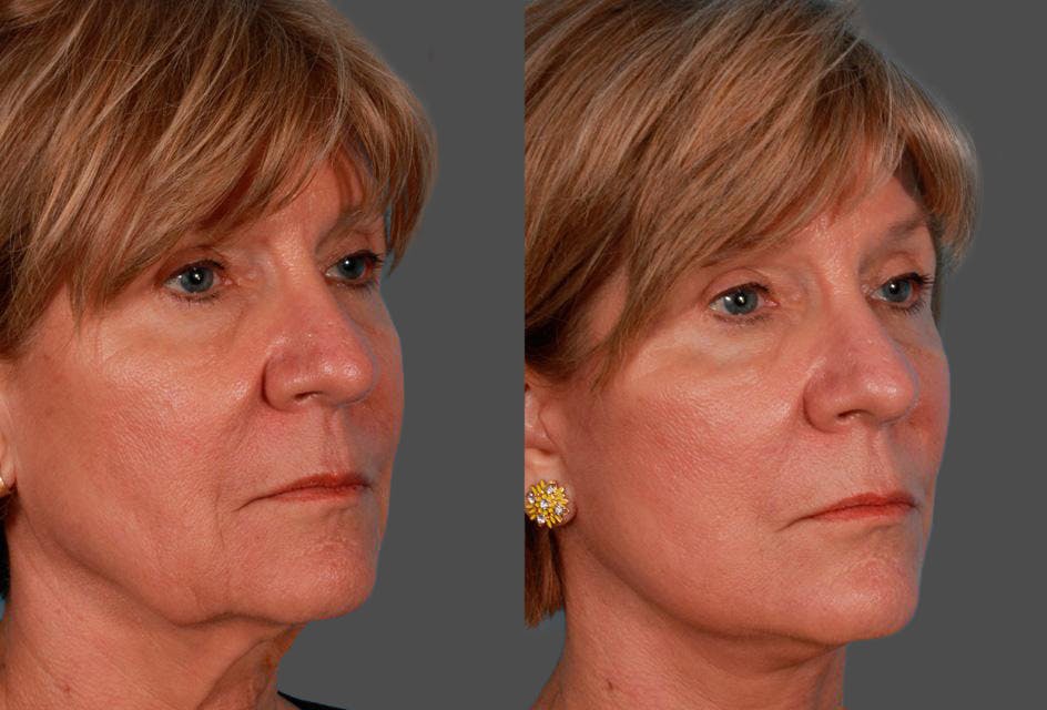 Facelift Before & After Gallery - Patient 504011 - Image 2